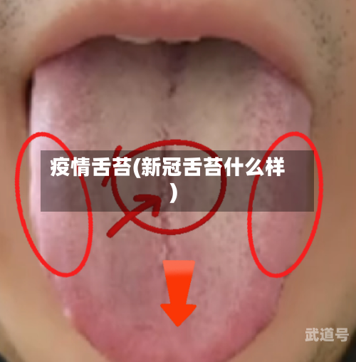 疫情舌苔(新冠舌苔什么样)